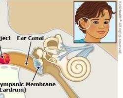 foreign object in ear canal illustration