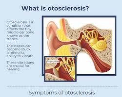 otosclerosis illustration